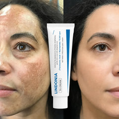(2x1) Lindonia® Corrector de Manchas